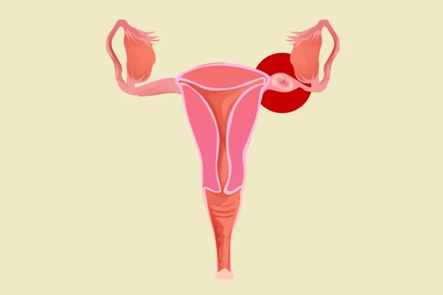 Ciąża pozamaciczna boli - poznaj objawy i kiedy szukać pomocy