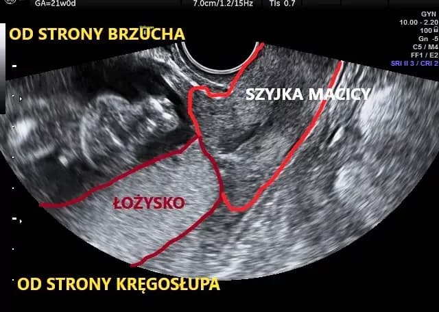 Jak oczyścić łożysko w ciąży i uniknąć poważnych problemów zdrowotnych
