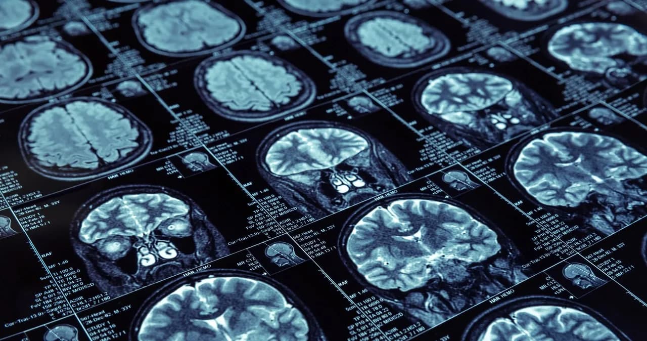 Jak zapobiec Alzheimerowi: Skuteczne metody na zmniejszenie ryzyka