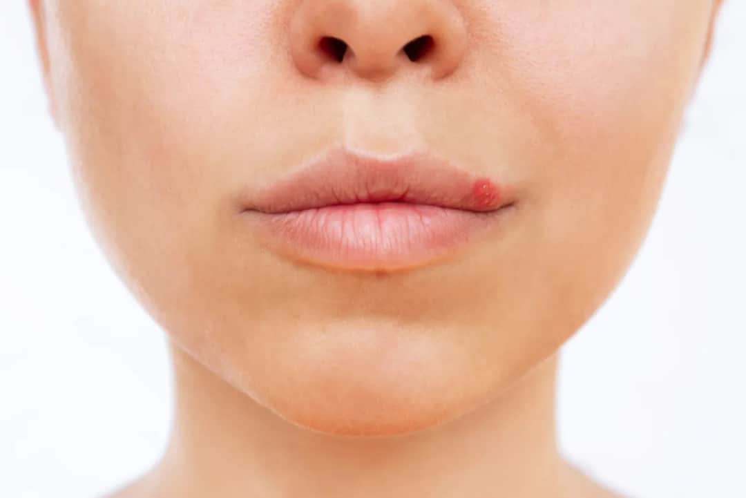 Jak zapobiec opryszczce: skuteczne metody, które naprawdę działają