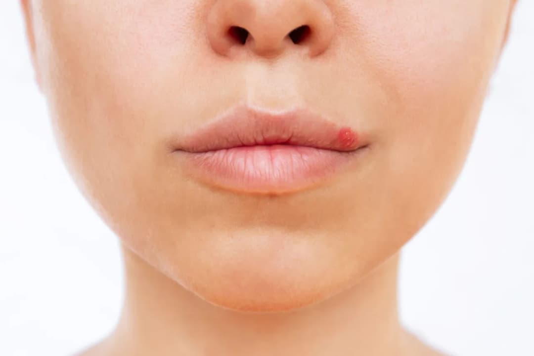 Jak zapobiec opryszczce: skuteczne metody, które naprawdę działają